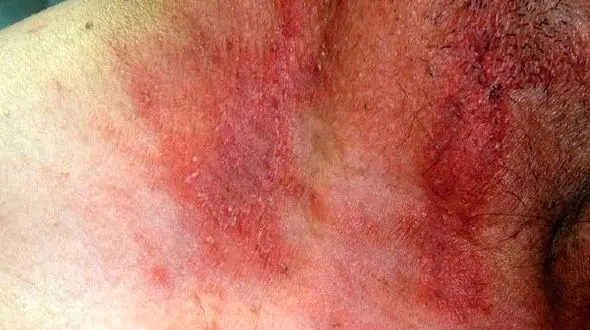 بلای وحشتناکی که این حشره بر سر قربانیانش می‌آورد+ تصاویر