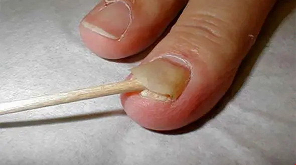 علت افتادن ناخن پا چیست؟ + راهکارهای درمانی