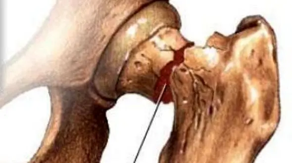 سه راهکار  اساسی در پیشگیری از پوکی استخوان