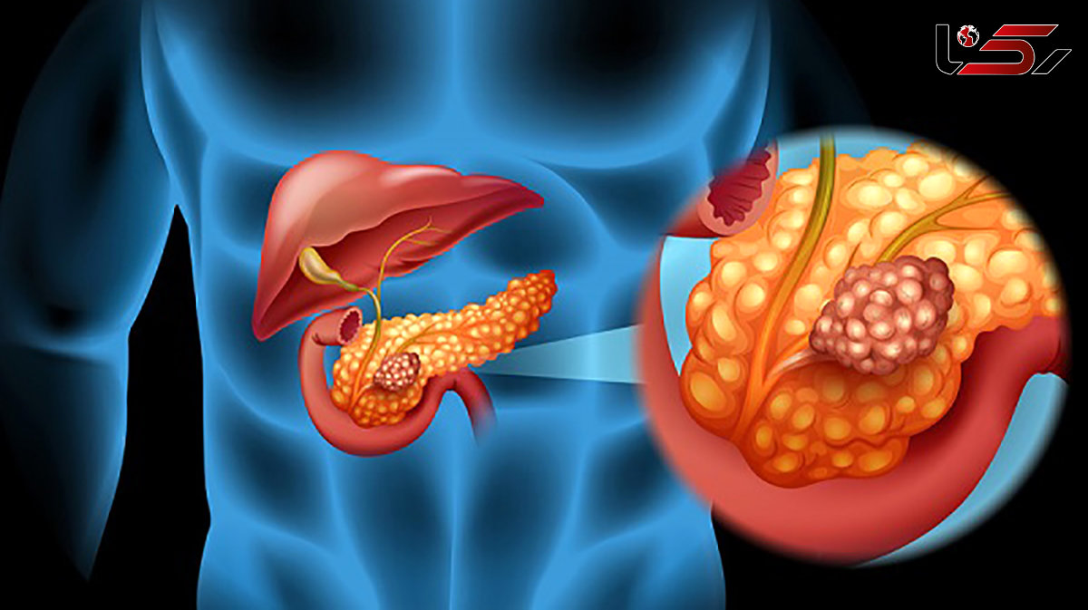 سالانه 4 هزار نفر در ایران به سرطان لوزالمعده مبتلا می شوند / مصرف دخانیات و چاقی از علل اصلی 