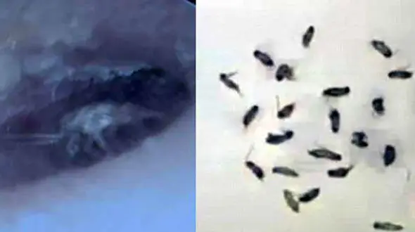 گوش یک جوان لانه ۲۶ سوسک بود!