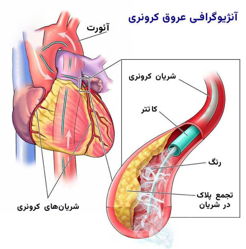 آنژیوگرافی عروق کرونری