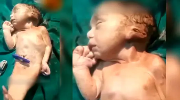 عکس های 11 انسان عجیب الخلقه جهان را ببینید ! / از مرد 4 چشم تا دختر پری دریایی !