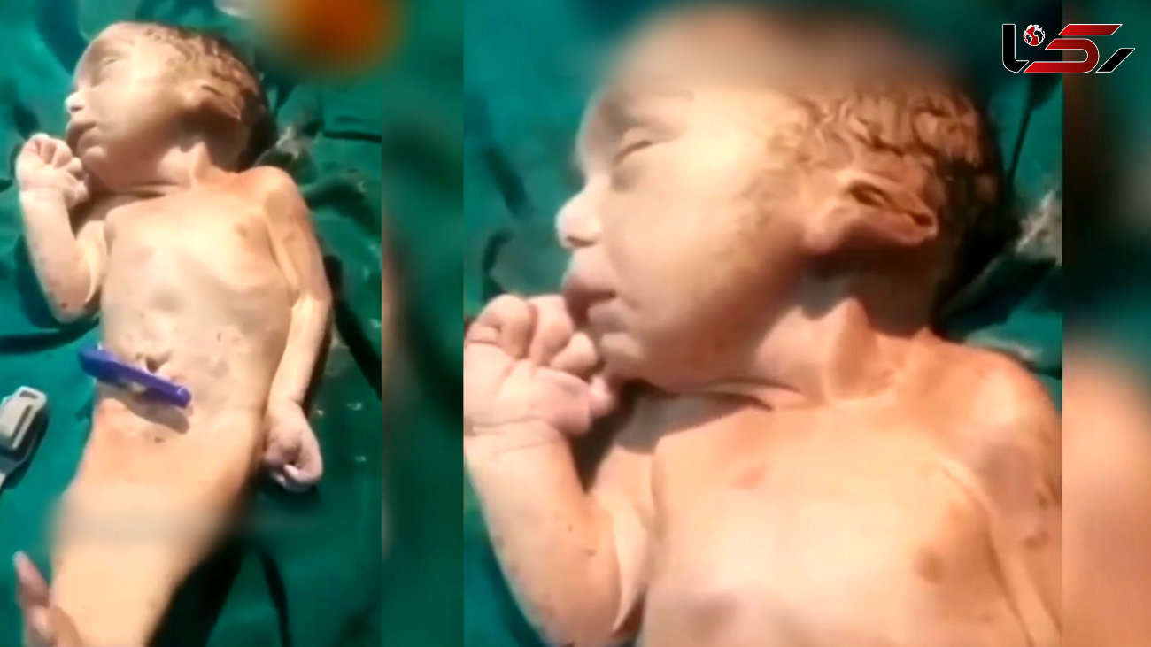فیلم  عجیب الخلقه ترین نوزاد دنیا  ! /  نه انسان است نه پری !