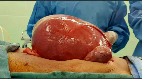 خروج توده رحمی ۳/۵ کیلویی از شکم دختر جوان