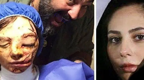 بازیگر معروف زن قربانی اسیدپاشی شد +عکس