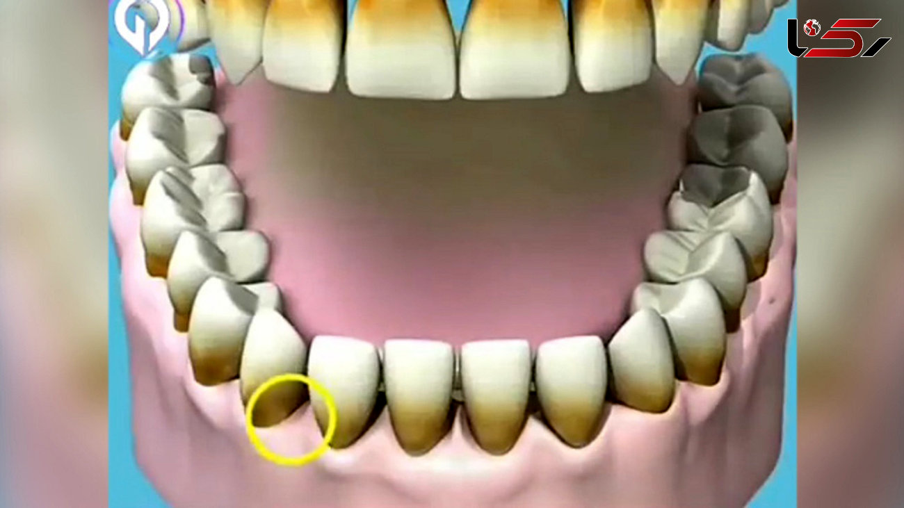 رتبه متوسط اردبیل در شاخص پوسیدگی دندان