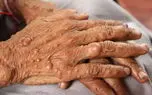 بیمه‌ها بیماری ژنتیکی نوروفیبروماتوز را پوشش نمی‌دهند/ جراحی هر توده 2 میلیون تومان، اما بیماران یکی دو تا توده ندارند!/ آمار دقیق این بیماری را اعلام نمی‌کنند 