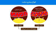 بررسی دیابت نوع یک و نوع 2 