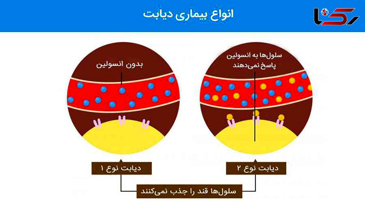 بررسی دیابت نوع یک و نوع 2 