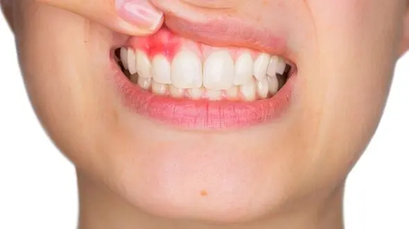 چرا لثه ها دچار خونریزی می شوند/نقش داروهای خاص در خونریزی لثه