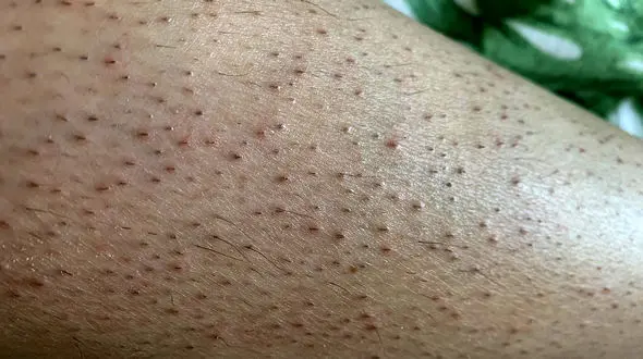 موی زیر پوستی چیست؟