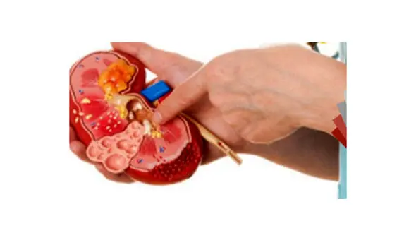 زنگ خطر سرطان کلیه