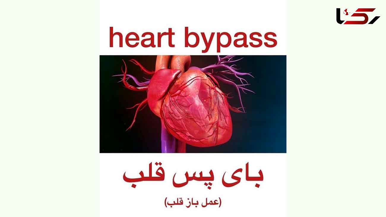 بای پس قلب چیست ؟ / فیلم جراحی قلب را ببینید 