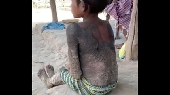 سرگذشت غم انگیز دختر بچه سنگی + عکس 