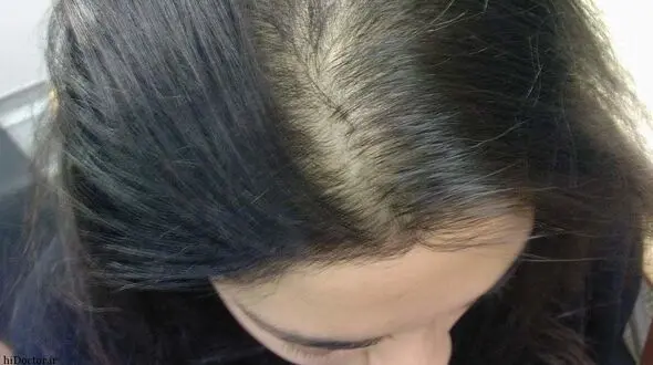 دلایل ریزش مو در زنان 