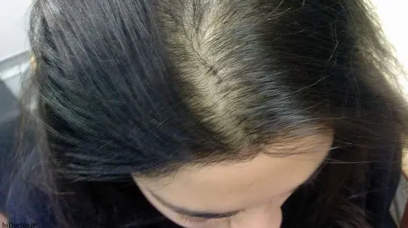 دلایل ریزش مو در زنان 