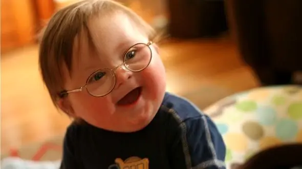 کرونا چه تاثیری روی کودکان سندروم داون می گذارد؟