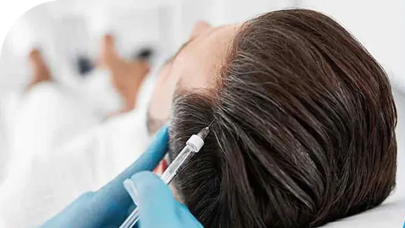 مزوتراپی مو