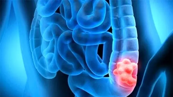 نشانه‌ های اولیه سرطان روده که نباید نادیده بگیرید