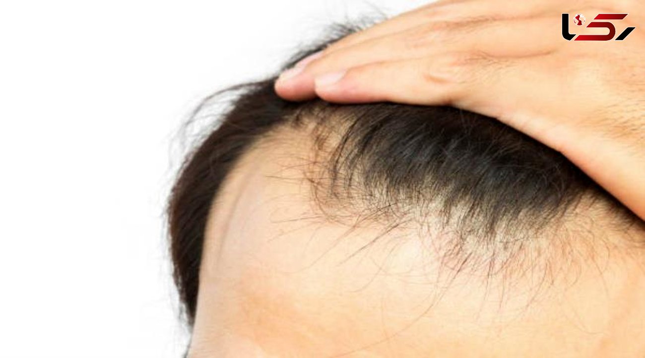 ریزش مو به دلیل 6 عادت اشتباه رایج