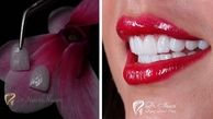 آشنایی با 7 تاثیر شگفت انگیز لمینت دندان بر زیبایی لبخند