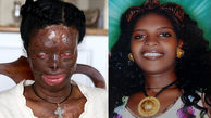 عکس چهره قبل و بعد از اسیدپاشی یک زن ! / او فقط طلاق خواست! / اتیوپی