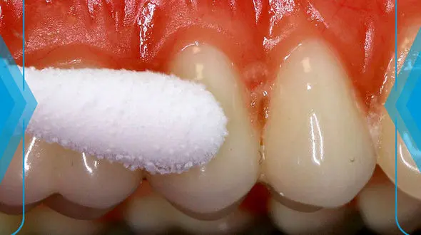 10 روش‌ خانگی برای درمان عفونت لثه