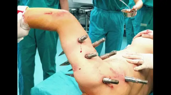 عکسی تکاندهنده از سوراخ سوراخ شدن بدن کارگر جوان+ عکس 16+