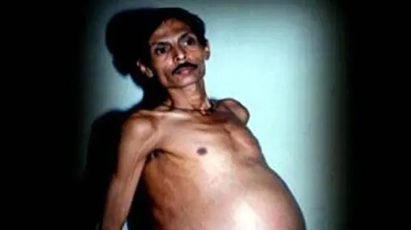 تولد نوزاد ناقص الخلقه از شکم مرد هندی باردار بعد از 36 سال! +عکس