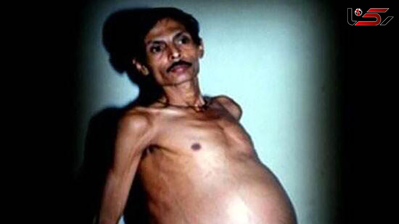 تولد نوزاد ناقص الخلقه از شکم مرد هندی باردار بعد از 36 سال! +عکس