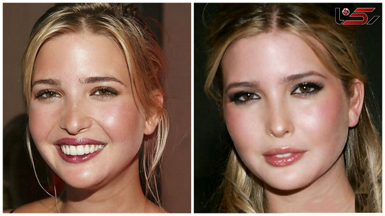 دختر ترامپ قبل و بعد از عمل زیبایی + عکس