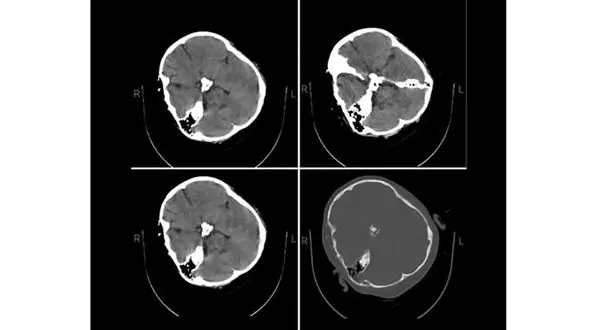 هیچ شواهدی از خونریزی مغزی در تصاویر سی‌تی‌اسکن «مهسا امینی» دیده نمی‌شود