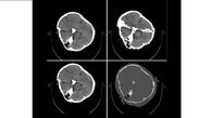 هیچ شواهدی از خونریزی مغزی در تصاویر سی‌تی‌اسکن «مهسا امینی» دیده نمی‌شود