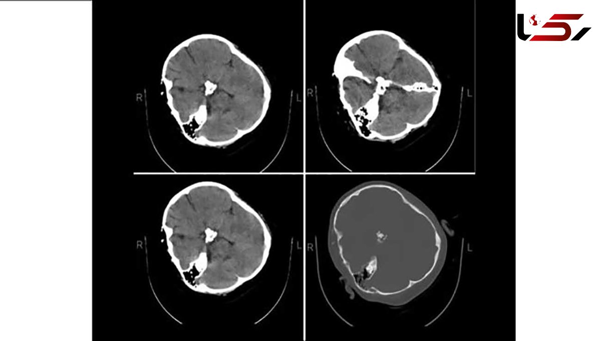 هیچ شواهدی از خونریزی مغزی در تصاویر سی‌تی‌اسکن «مهسا امینی» دیده نمی‌شود