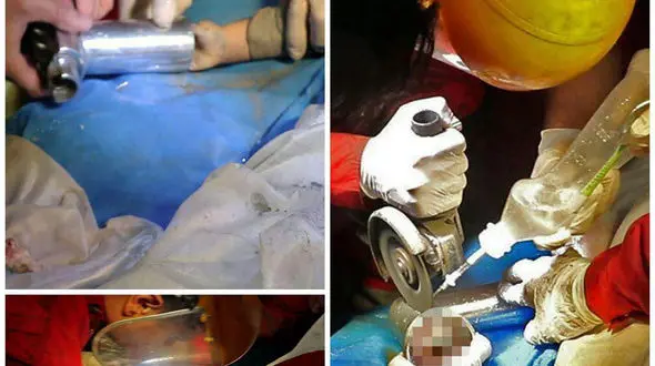 قطع شدن 4 انگشت یک  کودک مشهدی + عکس های تکاندهنده