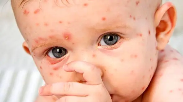 این افراد نگران آبله میمون نباشند