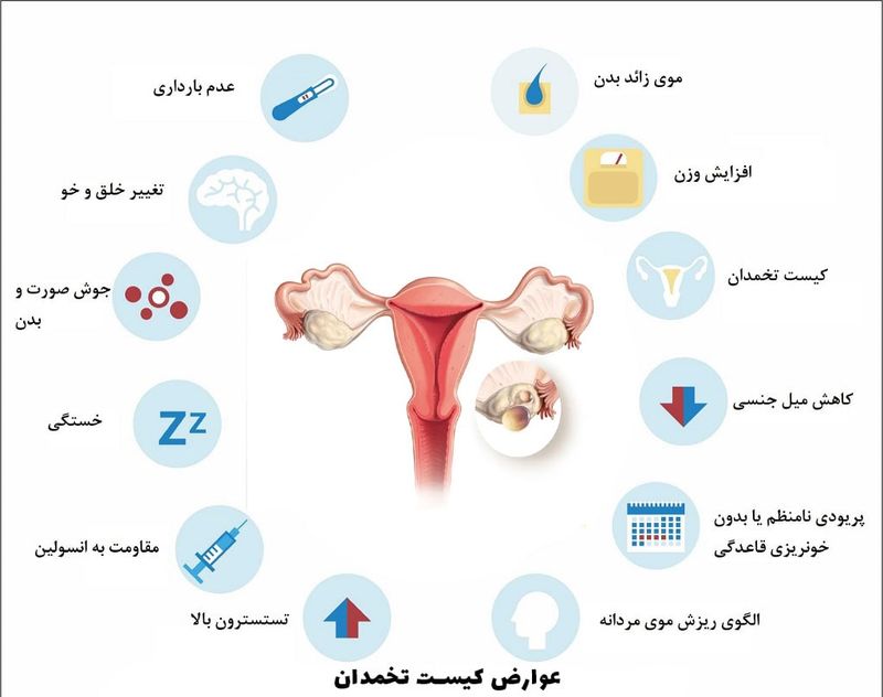 عوارض کیست تخمدان