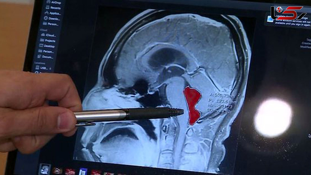 زندگی مرد جوان با یک کرم  در مغزش! + عکس / امریکا