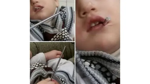 فرو رفتن میله در دهان کودک ۲ ساله تبریزی+ عکس ناراحت کننده