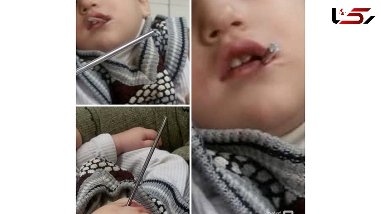 فرو رفتن میله در دهان کودک ۲ ساله تبریزی+ عکس ناراحت کننده