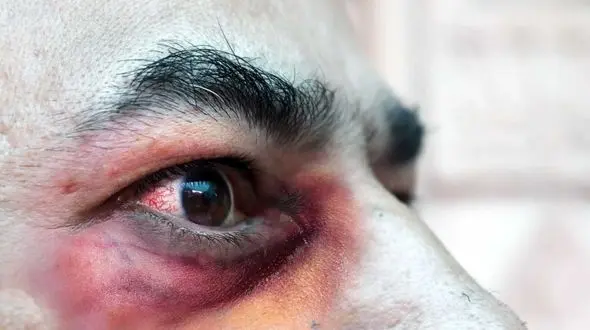 اولین نشانه ابتلا به قارچ سیاه + راه درمان