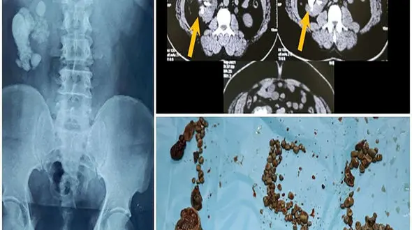 شوک پزشکان در اتاق عمل / کشف 156 سنگ در کلیه های مرد حیدرآبادی + عکس