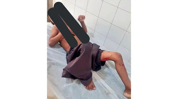 بلای وحشتناکی که بر سر پسر 8 ساله چابهاری زیر دندان های گاندو آمد+ عکس دلخراش