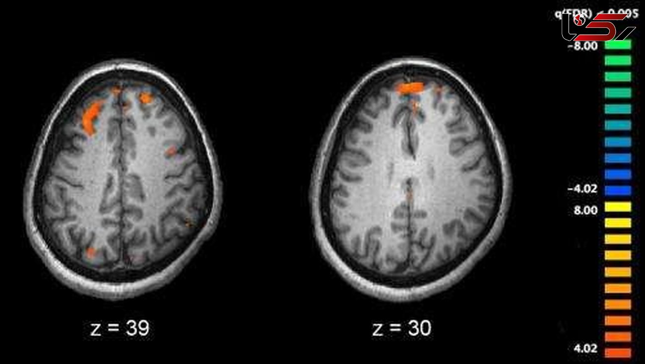 ژن اختلال اسکیزوفرنی در رشد مغز کشف شد