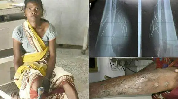 زن عجیبی که از پایش میخ و سوزن می بارد + تصاویر باورنکردنی