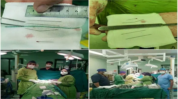 خارج کردن ۴ سوزن خیاطی از قلب و قفسه سینه زن اردبیلی + عکس