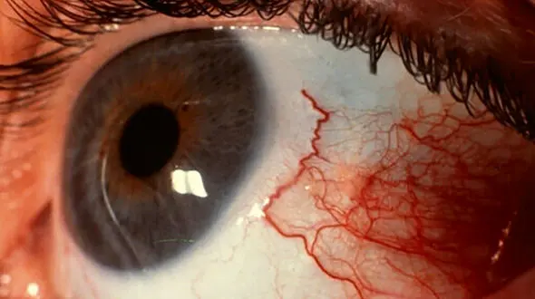 علائم اولیه و روش درمان عفونت انگلی آکانتامبا / اگر از لنز چشمی استفاده می کنید مراقب باشید