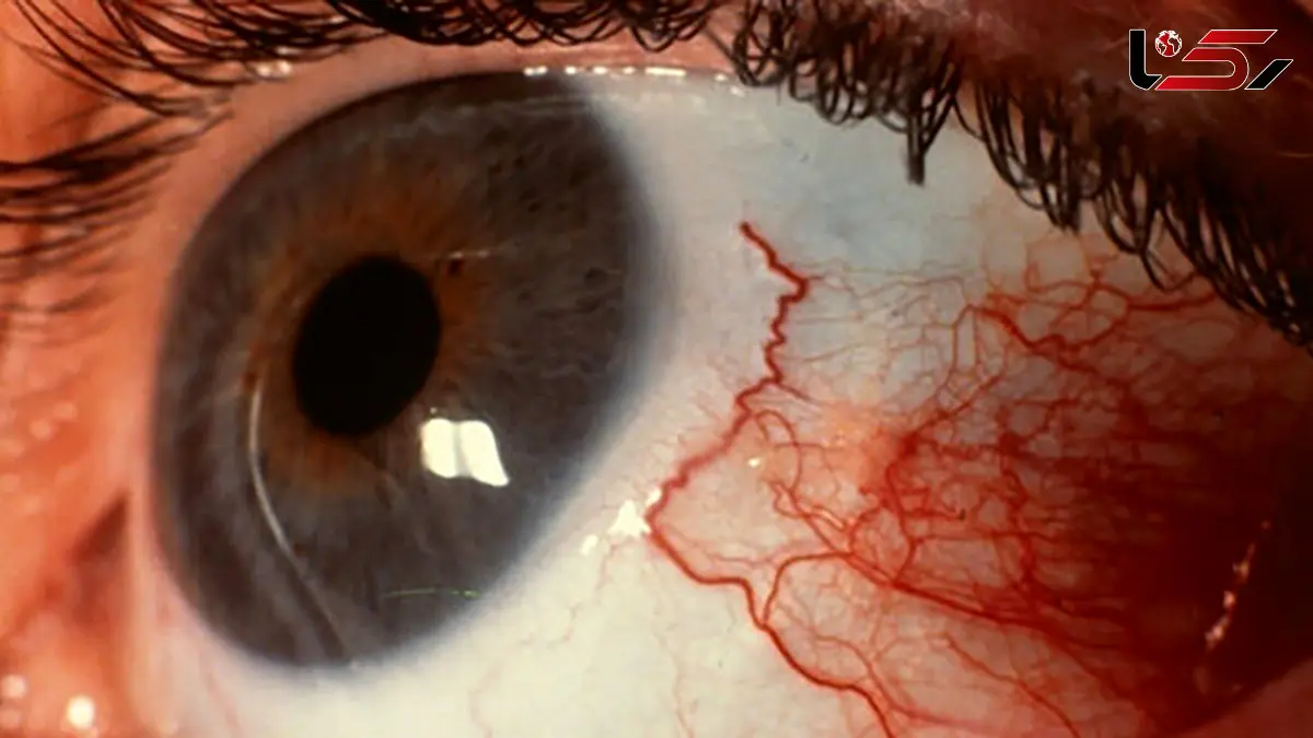 علائم اولیه و روش درمان عفونت انگلی آکانتامبا / اگر از لنز چشمی استفاده می کنید مراقب باشید