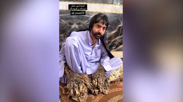 فریاد درد «مرد درختی» در خاش؛ مسئولان غایب، خیران در میدان!/ می گوید فقط ۵ میلیارد برای درمان نیاز است ! + فیلم